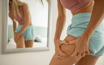cellulite