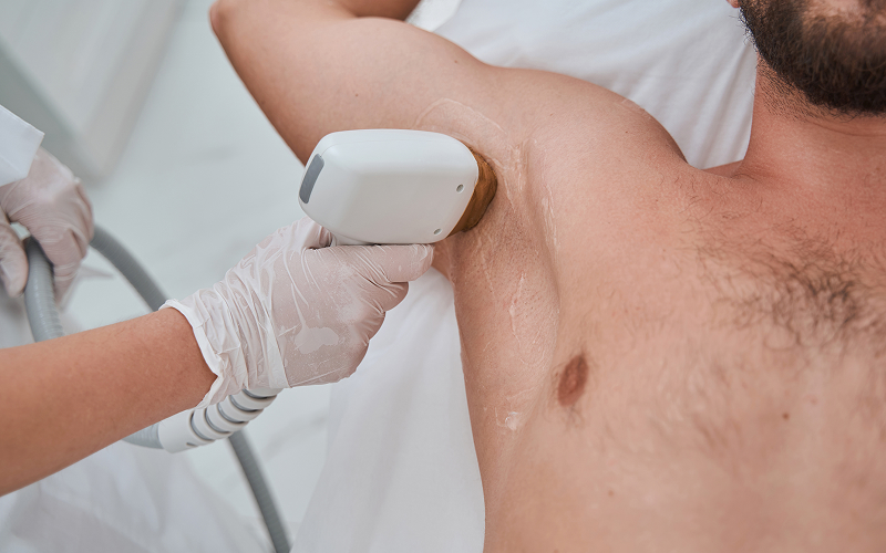 prix epilation laser